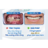 Trồng Răng Implant